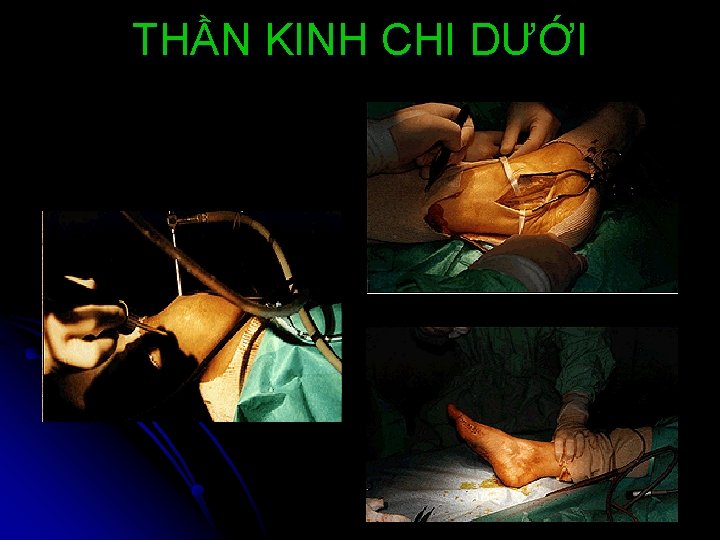 THẦN KINH CHI DƯỚI 