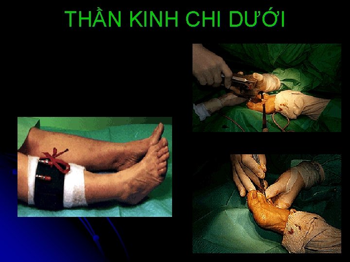 THẦN KINH CHI DƯỚI 
