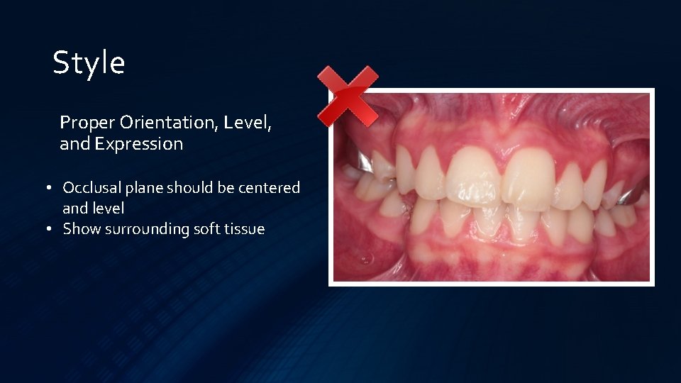 Style Proper Orientation, Level, and Expression • Occlusal plane should be centered and level