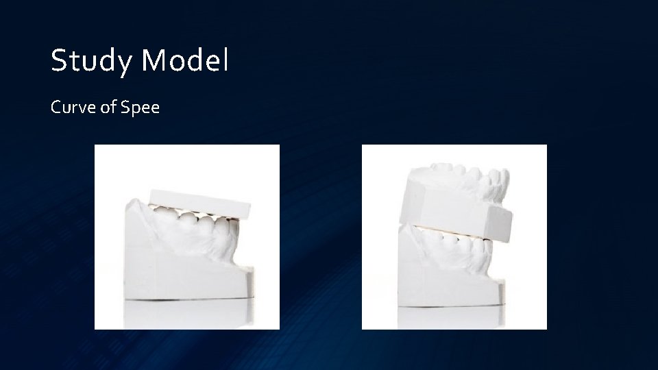 Study Model Curve of Spee 