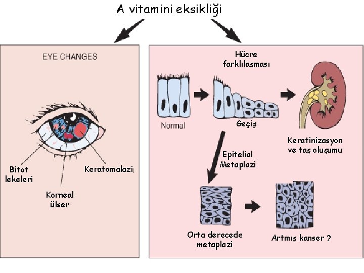 A vitamini eksikliği Hücre farklılaşması Geçiş Keratomalazi Bitot lekeleri Epitelial Metaplazi Keratinizasyon ve taş