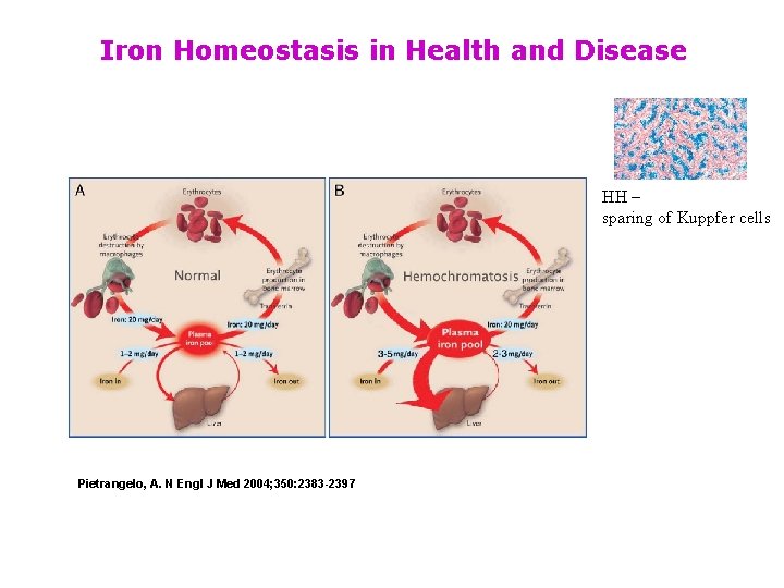 Iron Homeostasis in Health and Disease HH – sparing of Kuppfer cells Pietrangelo, A.