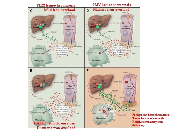 Tf. R 2 hemochromatosis Mild iron overload HAMP hemochromatosis Dramatic iron overload HJV hemochromatosis