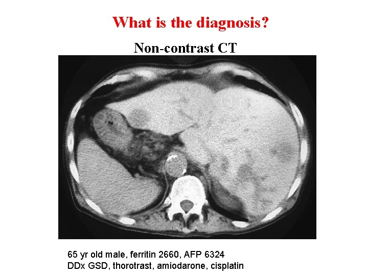 What is the diagnosis? Non-contrast CT 65 yr old male, ferritin 2660, AFP 6324