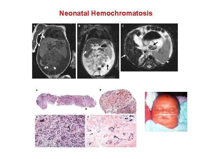 Neonatal Hemochromatosis Andrews, N. C. et al. N Engl J Med 2005; 353: 189