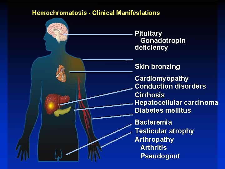 Clinical Manifestations Hemochromatosis - Clinical Manifestations Pituitary Gonadotropin deficiency Skin bronzing Cardiomyopathy Conduction disorders