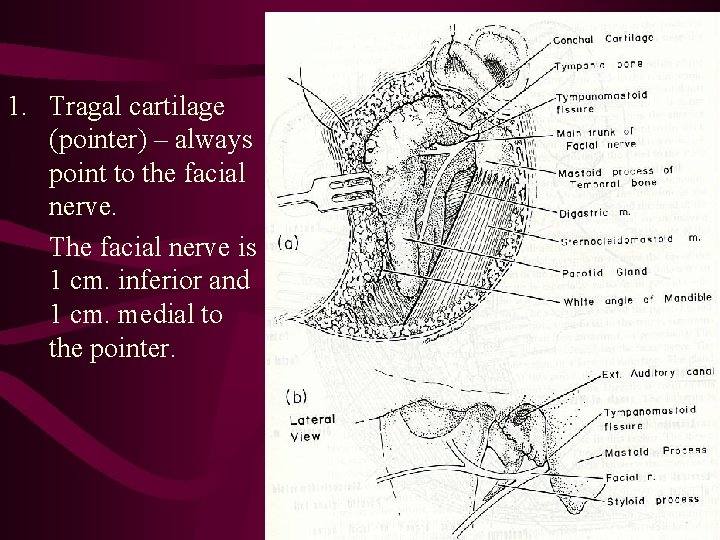 1. Tragal cartilage (pointer) – always point to the facial nerve. The facial nerve