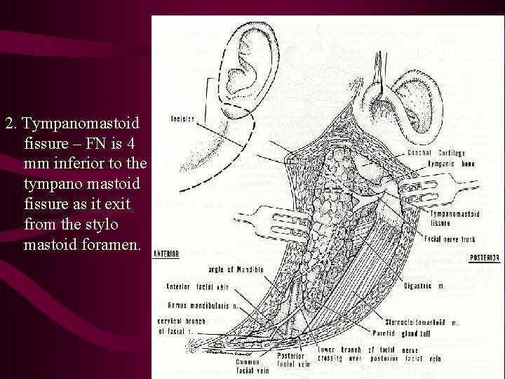 2. Tympanomastoid fissure – FN is 4 mm inferior to the tympano mastoid fissure