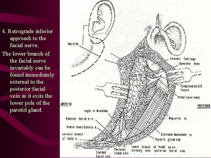 4. Retrograde inferior approach to the facial nerve. The lower branch of the facial