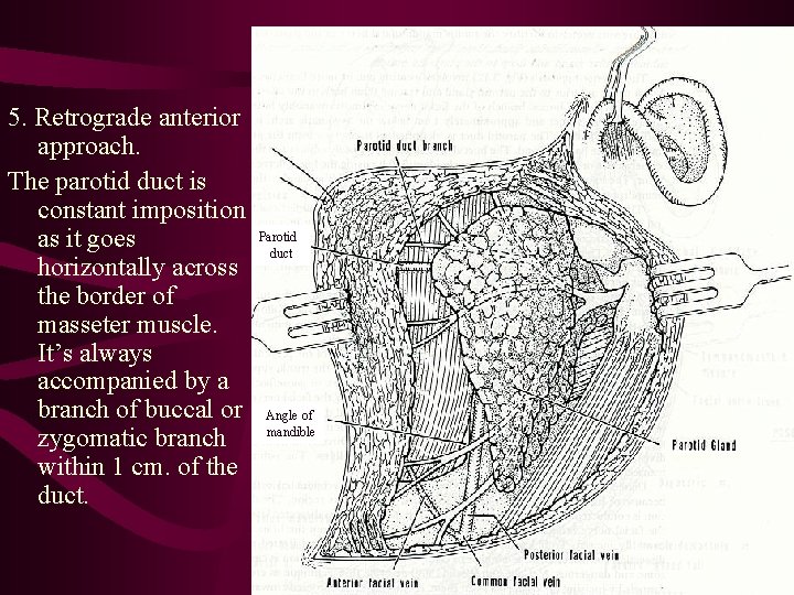 5. Retrograde anterior approach. The parotid duct is constant imposition as it goes horizontally