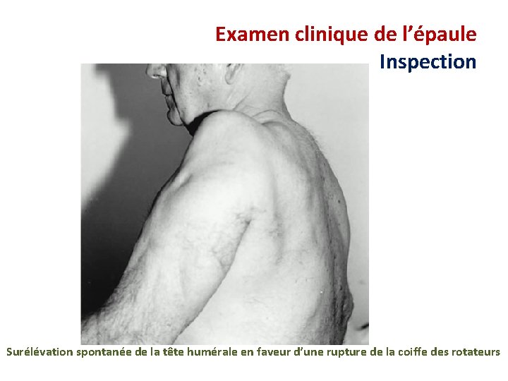 Examen clinique de l’épaule Inspection Surélévation spontanée de la tête humérale en faveur d’une
