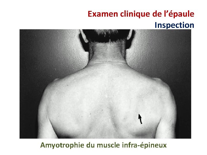 Examen clinique de l’épaule Inspection Amyotrophie du muscle infra-épineux 
