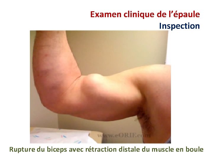 Examen clinique de l’épaule Inspection Rupture du biceps avec rétraction distale du muscle en