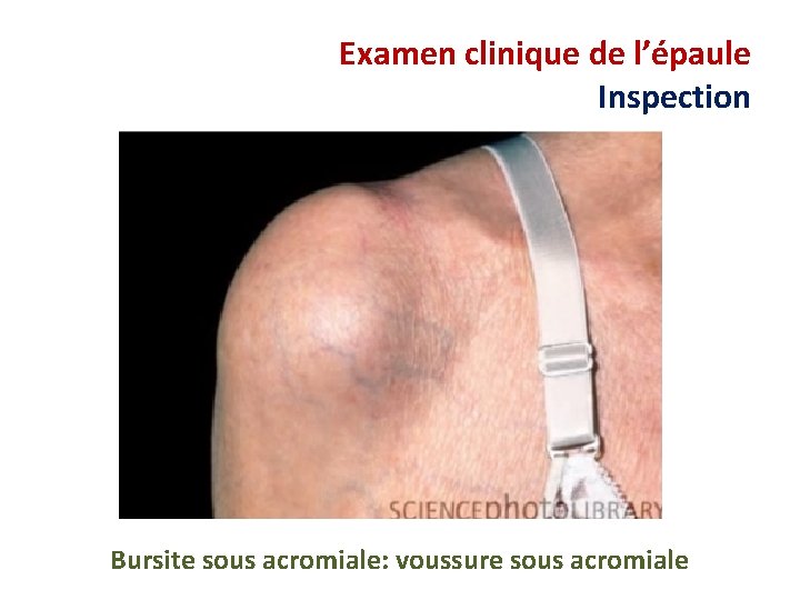 Examen clinique de l’épaule Inspection Bursite sous acromiale: voussure sous acromiale 