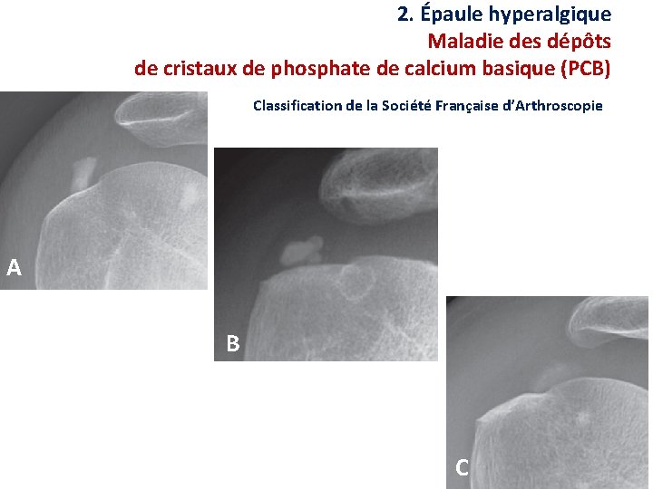 2. Épaule hyperalgique Maladie des dépôts de cristaux de phosphate de calcium basique (PCB)