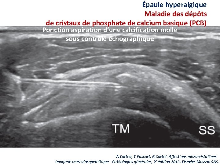 Épaule hyperalgique Maladie des dépôts de cristaux de phosphate de calcium basique (PCB) Ponction