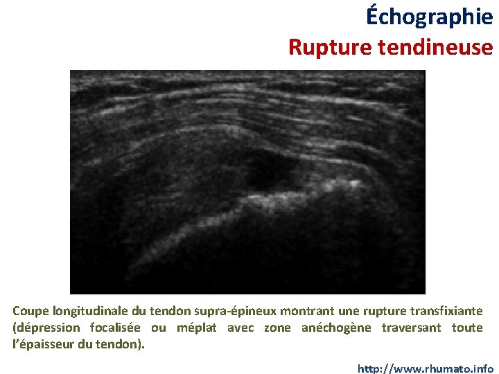 Échographie Rupture tendineuse Coupe longitudinale du tendon supra-épineux montrant une rupture transfixiante (dépression focalisée