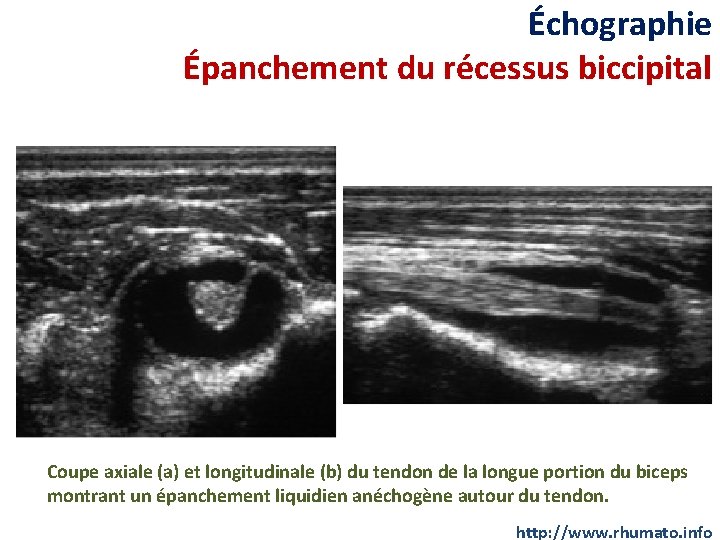 Échographie Épanchement du récessus biccipital Coupe axiale (a) et longitudinale (b) du tendon de