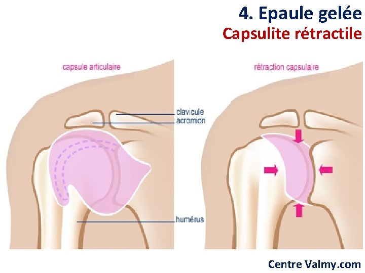 4. Epaule gelée Capsulite rétractile Centre Valmy. com 