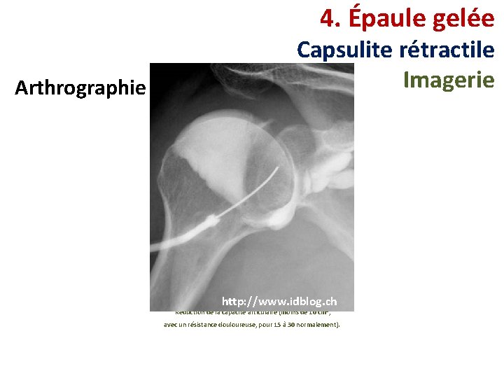4. Épaule gelée Arthrographie Capsulite rétractile Imagerie http: //www. idblog. ch Réduction de la