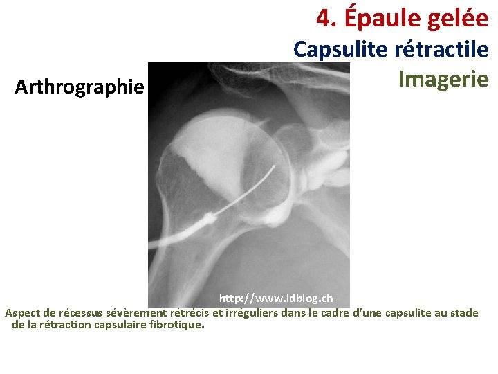 4. Épaule gelée Arthrographie Capsulite rétractile Imagerie http: //www. idblog. ch Aspect de récessus