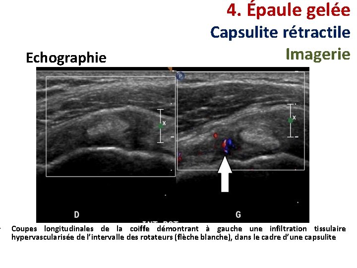  • 4. Épaule gelée Echographie Capsulite rétractile Imagerie Coupes longitudinales de la coiffe