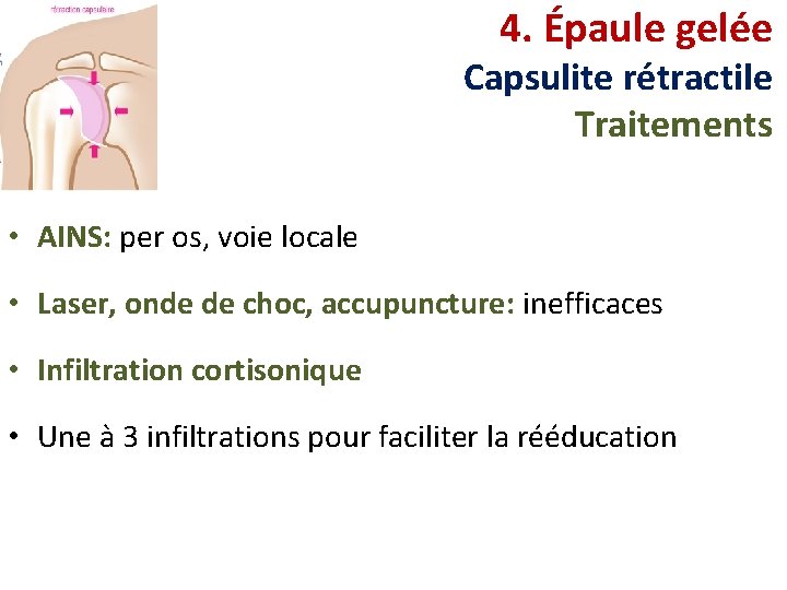4. Épaule gelée Capsulite rétractile Traitements • AINS: per os, voie locale • Laser,