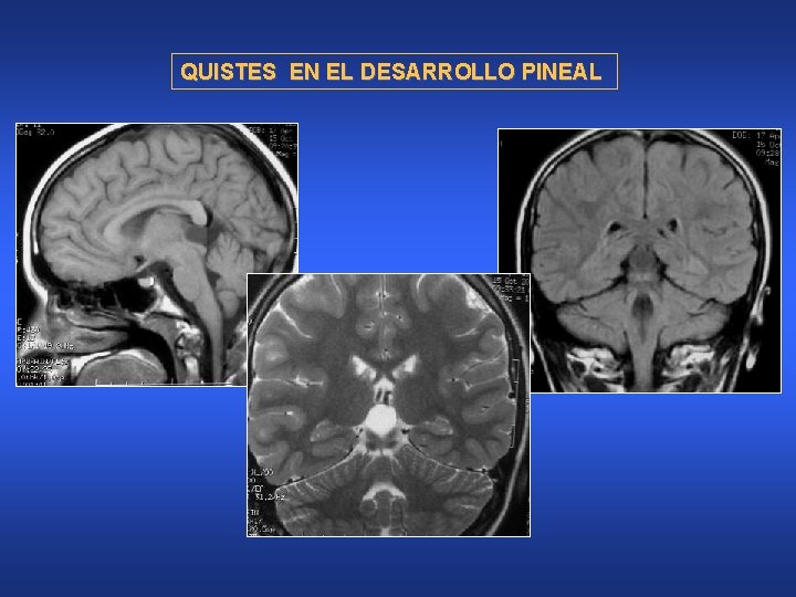 QUISTES EN EL DESARROLLO PINEAL 