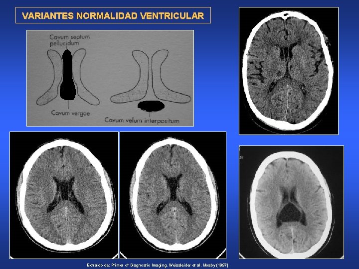 VARIANTES NORMALIDAD VENTRICULAR Extraído de: Primer of Diagnostic Imaging. Weissleider et al. Mosby (1997)