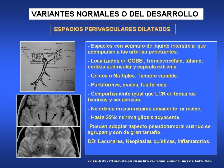 VARIANTES NORMALES O DEL DESARROLLO ESPACIOS PERIVASCULARES DILATADOS - Espacios con acúmulo de líquido