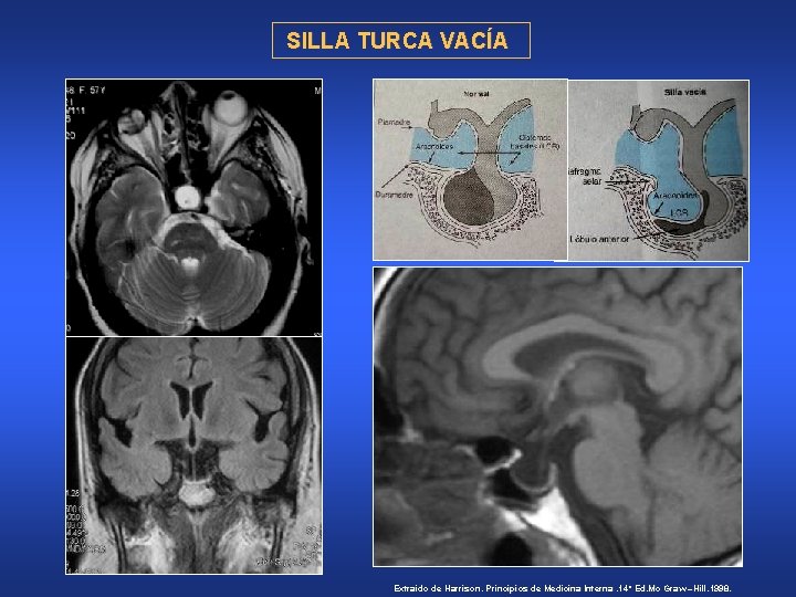 SILLA TURCA VACÍA Extraído de Harrison. Principios de Medicina Interna. 14º Ed. Mc Graw