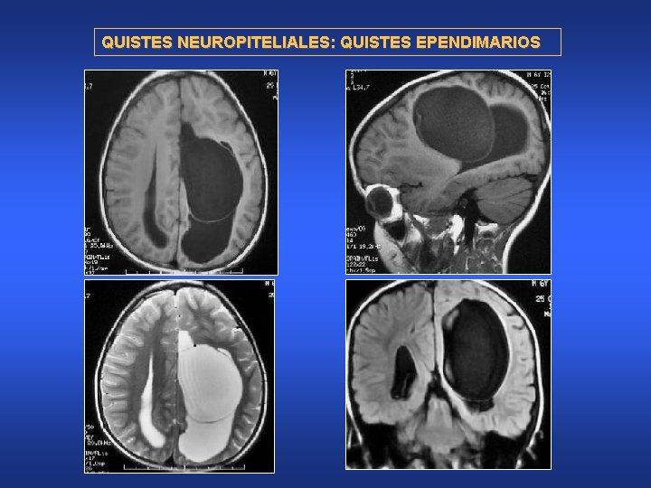 QUISTES NEUROPITELIALES: QUISTES EPENDIMARIOS 