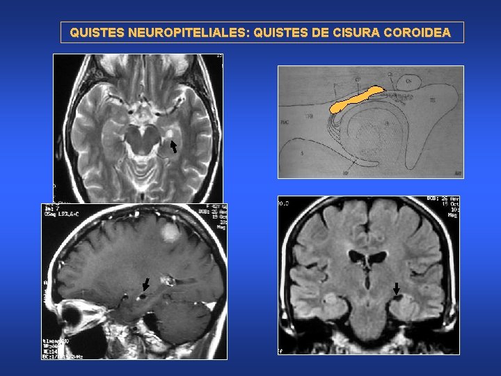 QUISTES NEUROPITELIALES: QUISTES DE CISURA COROIDEA 