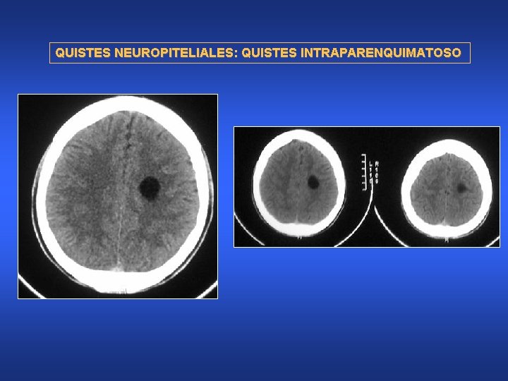 QUISTES NEUROPITELIALES: QUISTES INTRAPARENQUIMATOSO 