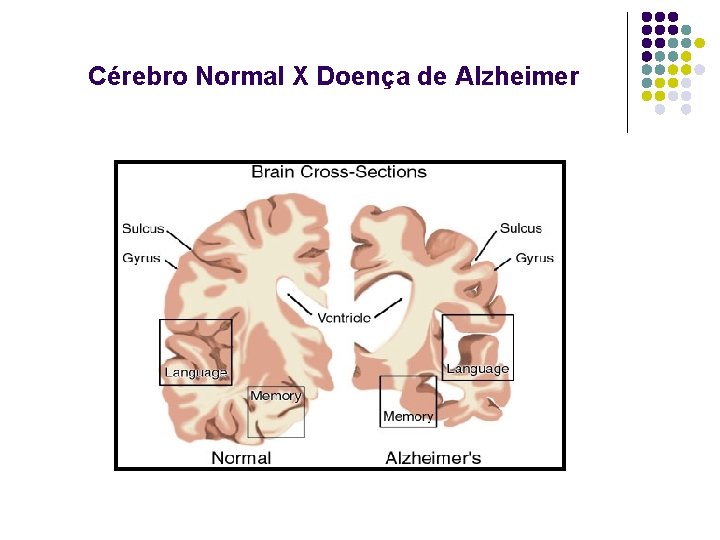 Cérebro Normal X Doença de Alzheimer 