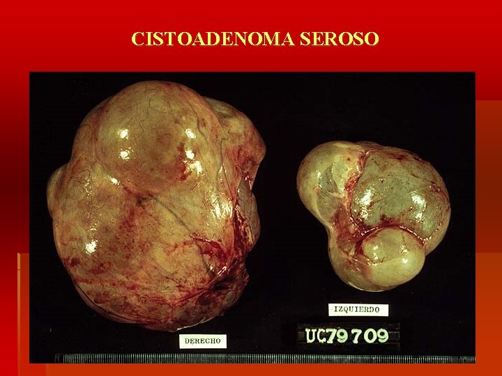 CISTOADENOMA SEROSO 