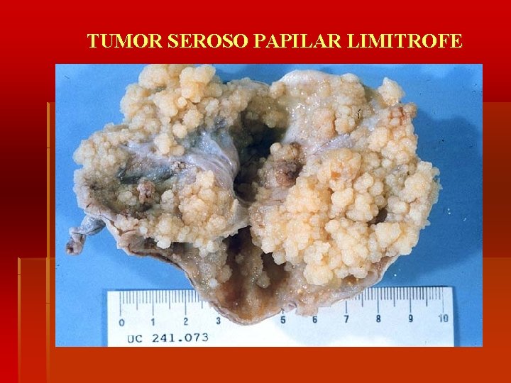 TUMOR SEROSO PAPILAR LIMITROFE 