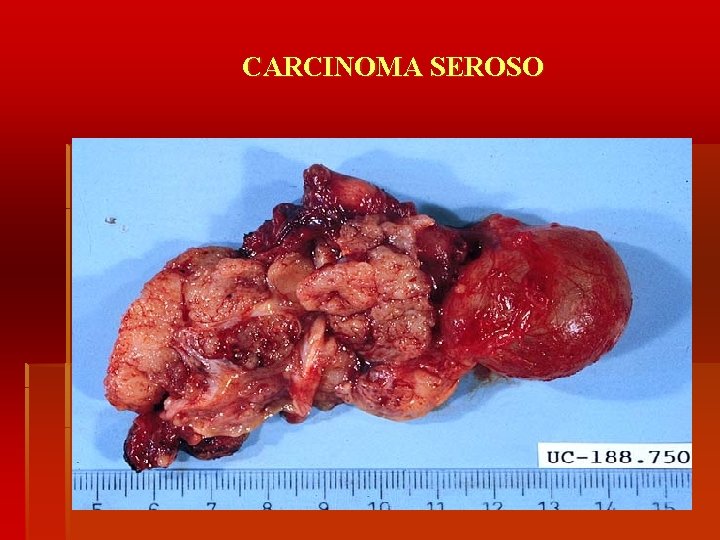 CARCINOMA SEROSO 