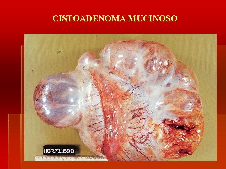 CISTOADENOMA MUCINOSO 