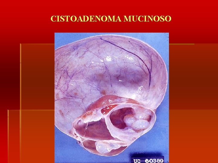 CISTOADENOMA MUCINOSO 