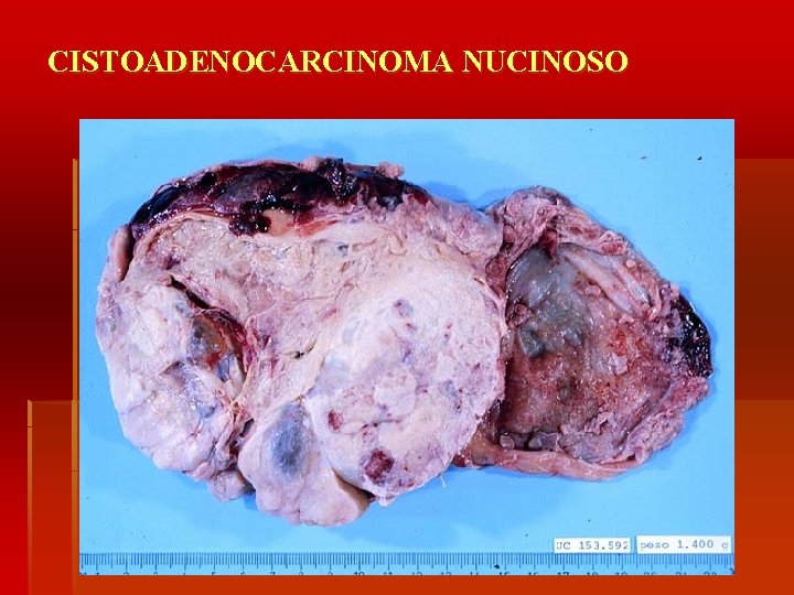 CISTOADENOCARCINOMA NUCINOSO 