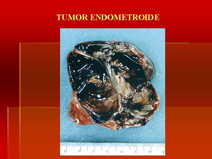 TUMOR ENDOMETROIDE 