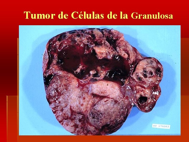 Tumor de Células de la Granulosa 