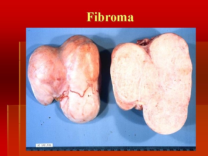 Fibroma 