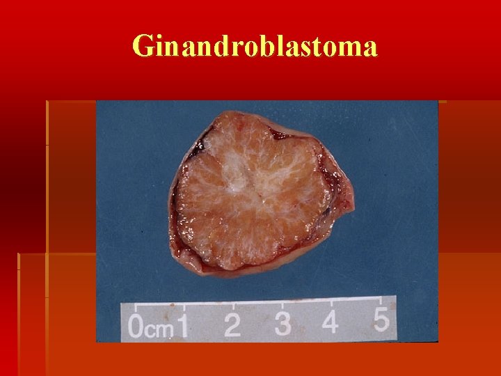 Ginandroblastoma 