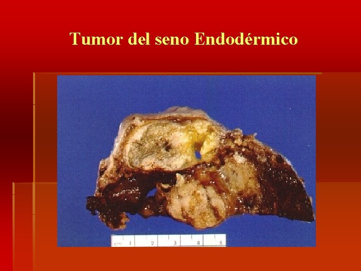 Tumor del seno Endodérmico 