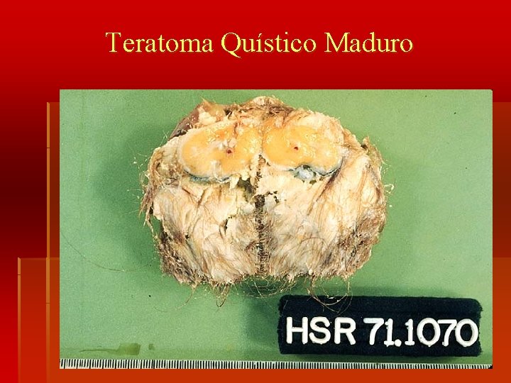 Teratoma Quístico Maduro 