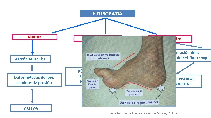 NEUROPATÍA Motora Sensitiva Alteración sudoral Atrofia muscular Deformidades del pie, cambios de presión Autonómica