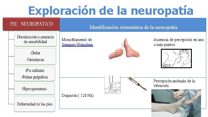 Exploración de la neuropatía Identificación sistemática de la neuropatía Monofilamento de Semmes Weinstein Ausencia