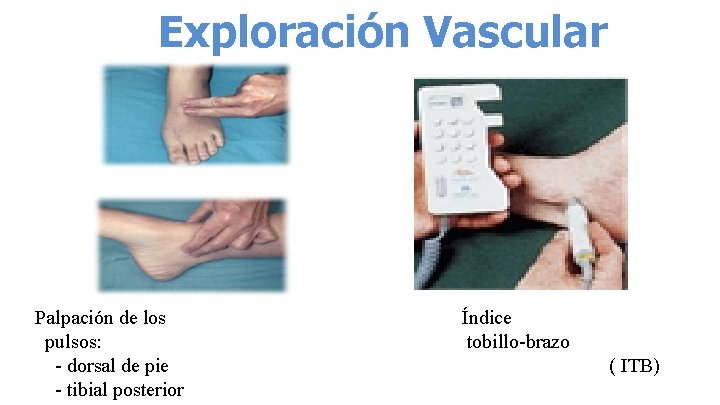 Exploración Vascular Palpación de los pulsos: - dorsal de pie - tibial posterior Índice